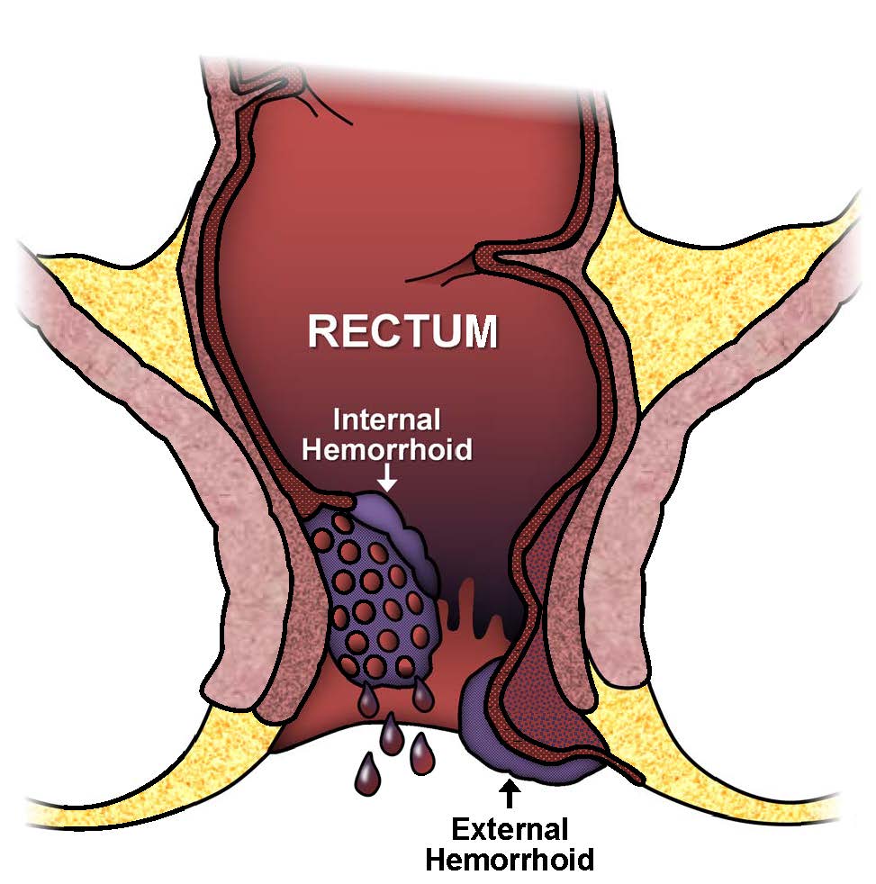 Prevention of hemorrhoids
